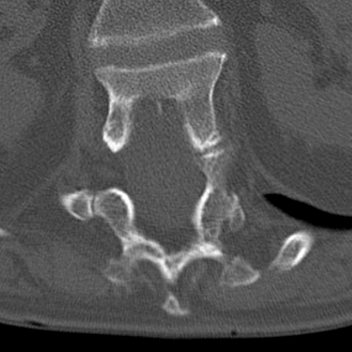 Butterfly vertebrae with kyphoscoliosis (Radiopaedia 14257-14133 Axial bone window 63).jpg