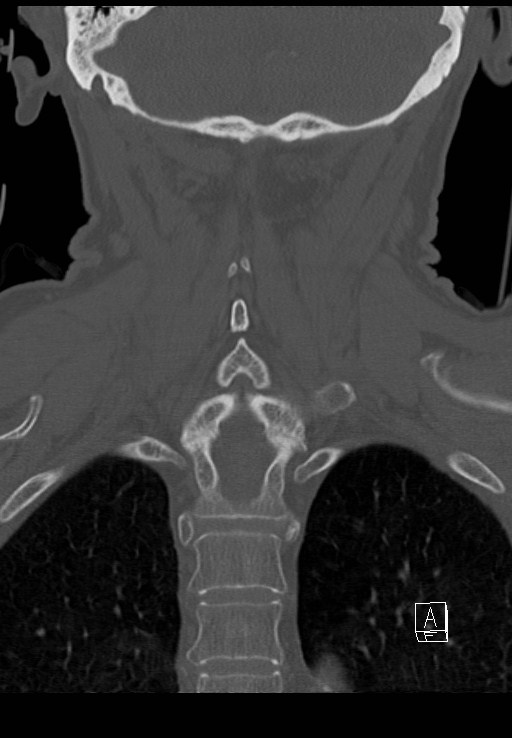 C1 and C2 (peg) fractures (Radiopaedia 36618-38184 Coronal bone window 38).jpg