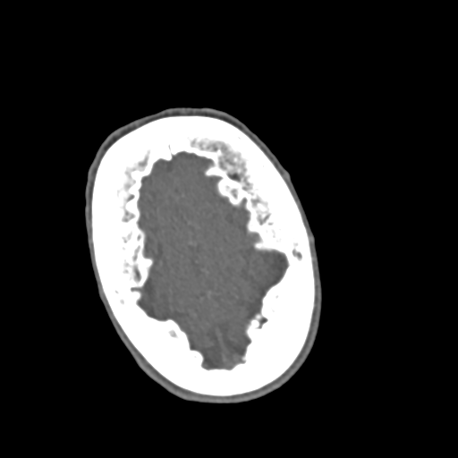 File:C2 fracture with vertebral artery dissection (Radiopaedia 37378-39200 A 296).png