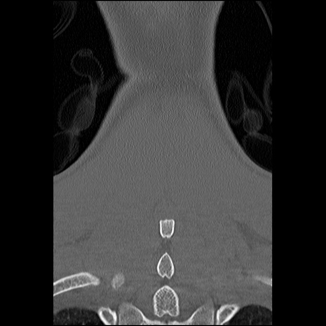 C5 facet fracture (Radiopaedia 58374-65499 Coronal bone window 55).jpg
