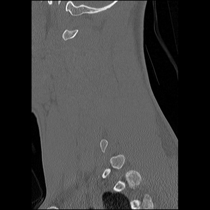 C5 facet fracture (Radiopaedia 58374-65499 Sagittal bone window 22).jpg