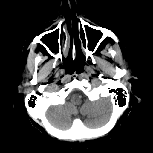 File:CNS lymphoma (Radiopaedia 36983-38639 Axial non-contrast 8).png