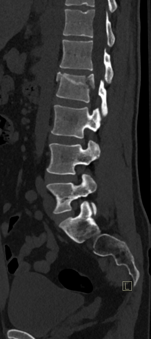 Calcaneal fractures with associated L2 burst fracture (Radiopaedia 71671-82493 Sagittal bone window 27).jpg