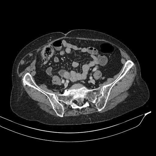 Calcified adrenal glands and Spigelian hernia (Radiopaedia 49741-54988 A 168).jpg