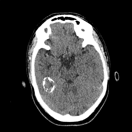 Calcified cerebral hydatid cyst (Radiopaedia 65603-74717 Axial non-contrast 22).jpg