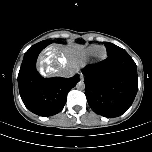 File:Calcified hepatic hydatid cyst (Radiopaedia 83870-99072 Axial non-contrast 14).jpg