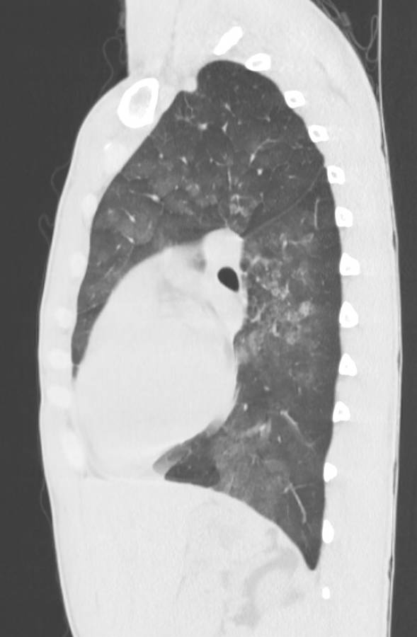 Cannabis-induced diffuse alveolar hemorrhage (Radiopaedia 89834-106946 Sagittal lung window 87).jpg