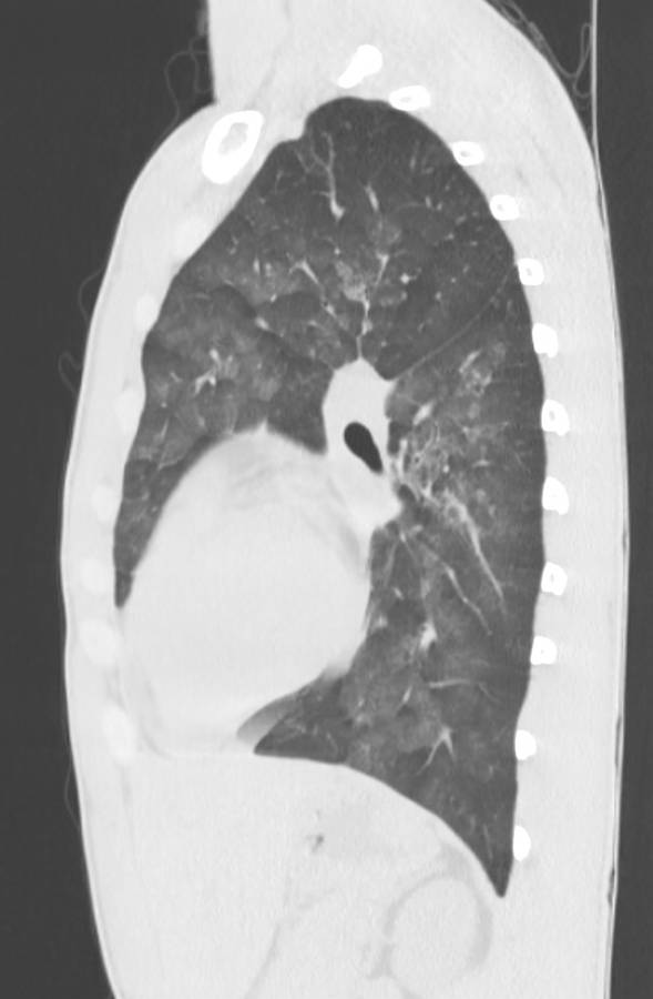 Cannabis-induced diffuse alveolar hemorrhage (Radiopaedia 89834-106946 Sagittal lung window 90).jpg