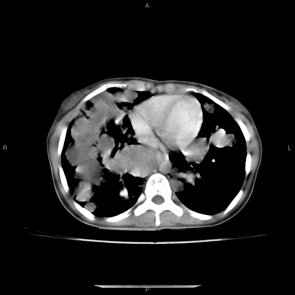File:Cannon ball metastases - synovial sarcoma (Radiopaedia 26135-26271 C 25).jpg