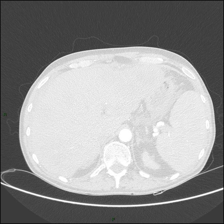 Cannonball metastases (Radiopaedia 82110-96150 Axial lung window 191).jpg