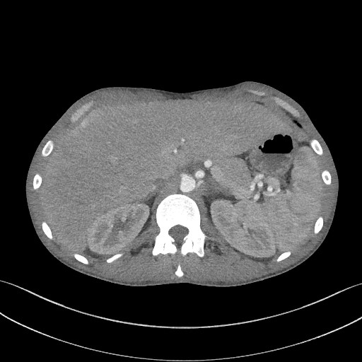 Cannonball metastases - testicular choriocarcinoma (Radiopaedia 84510-99891 B 108).jpg