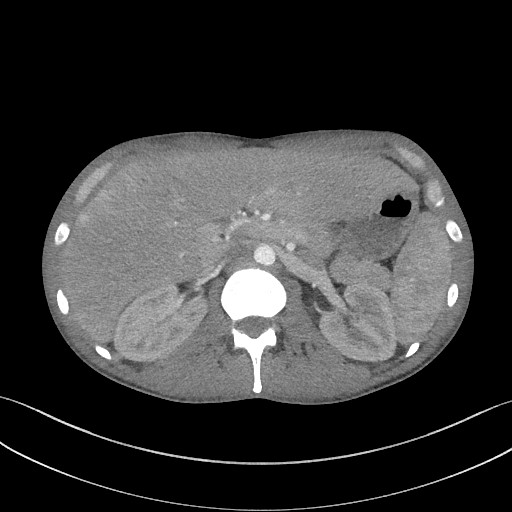 Cannonball metastases - testicular choriocarcinoma (Radiopaedia 84510-99891 B 114).jpg