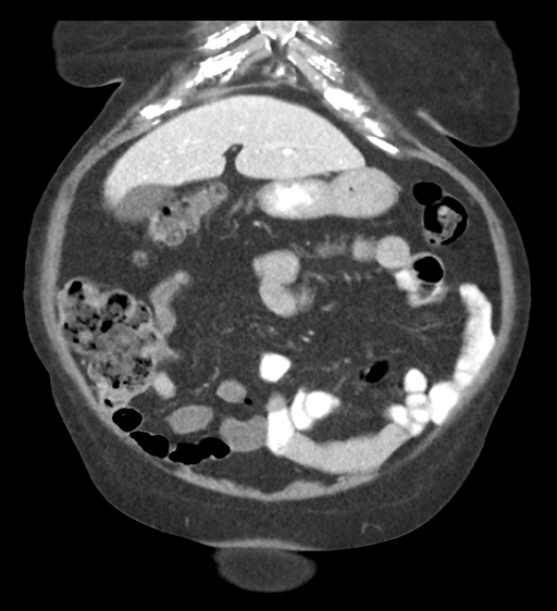 Cannonball metastases from endometrial cancer (Radiopaedia 42003-45031 F 20).png