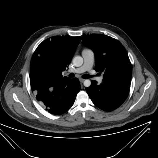 File:Cannonball pulmonary metastases (Radiopaedia 67684-77101 D 124).jpg