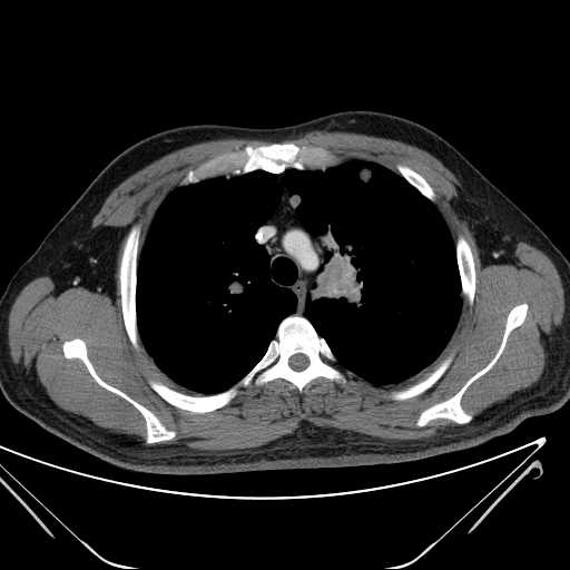 File:Cannonball pulmonary metastases (Radiopaedia 67684-77101 D 78).jpg