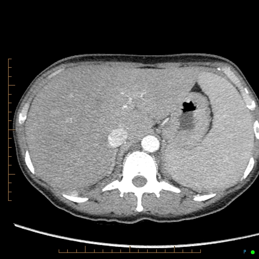 Canonball lung metastasis (Radiopaedia 77634-89837 B 99).jpg