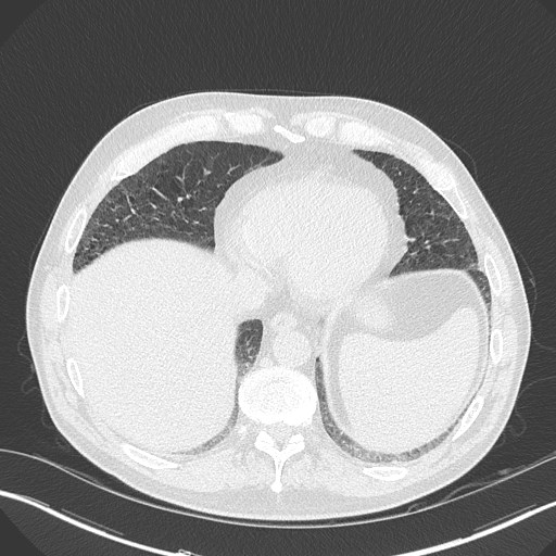 Caplan syndrome (Radiopaedia 56667-63530 Axial lung window 151).jpg