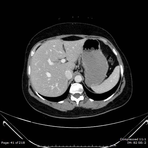 Carcinoid syndrome (Radiopaedia 52706-58626 A 21).jpg