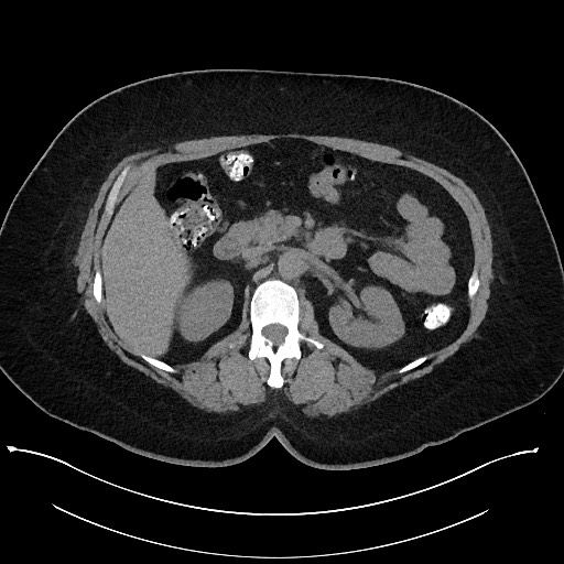 Carcinoid tumor - terminal ileum (Radiopaedia 60931-68740 Axial non-contrast 38).jpg