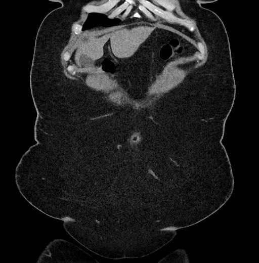 Carcinoid tumor - terminal ileum (Radiopaedia 60931-68740 Coronal non-contrast 9).jpg