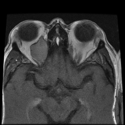 File:Carcinoid tumor of the ileum with metastasis to orbit (Radiopaedia 28165-28424 Axial T1 14).jpg