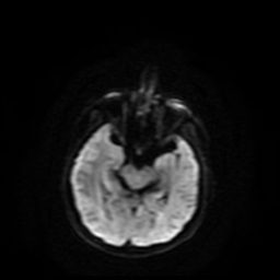 Carcinoma ex-pleomorphic adenoma of parotid (Radiopaedia 28383-28627 Ax DWI B-500 GE 69).jpg