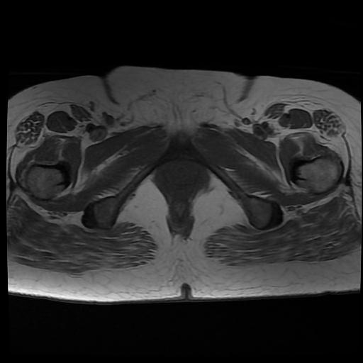 File:Carcinoma of the cervix (Radiopaedia 89018-105858 Axial T1 17).jpg