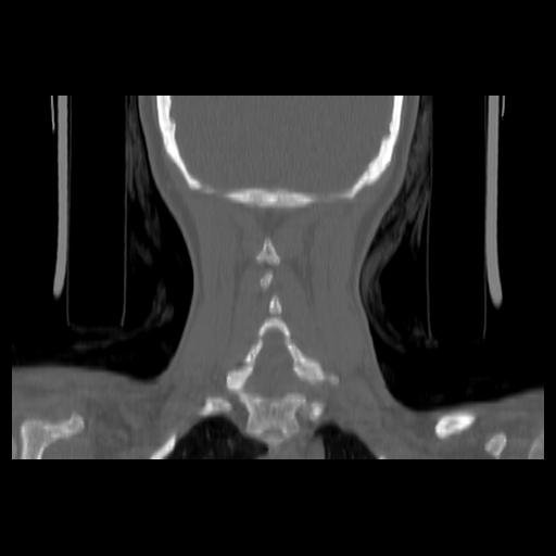Carcinoma of the maxillary antrum (Radiopaedia 53805-59888 Coronal bone window 125).jpg