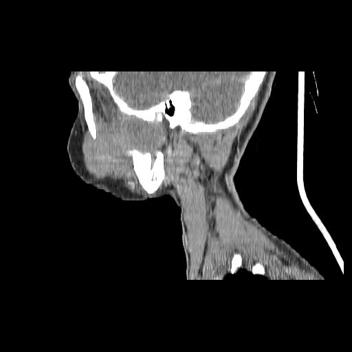 Carcinoma of the maxillary antrum (Radiopaedia 53805-59888 Sagittal C+ delayed 45).jpg