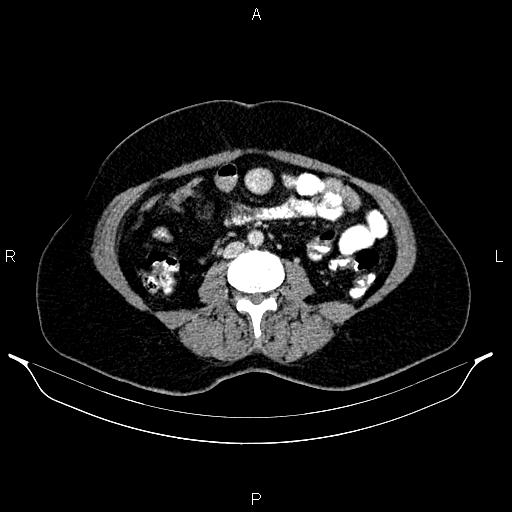 Carcinoma of uterine cervix (Radiopaedia 85861-101700 A 52).jpg