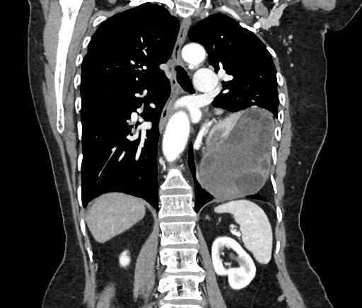 Cardiac hydatid disease (Radiopaedia 64684-73611 Axial reconstruction 36).jpg