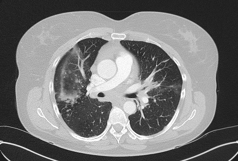 File:Cardiac sarcoidosis (Radiopaedia 74548-85534 Axial lung window 37).jpg