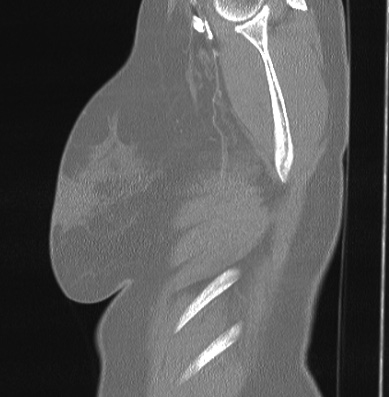 Cardiac sarcoidosis (Radiopaedia 74548-85534 Sagittal lung window 1).jpg