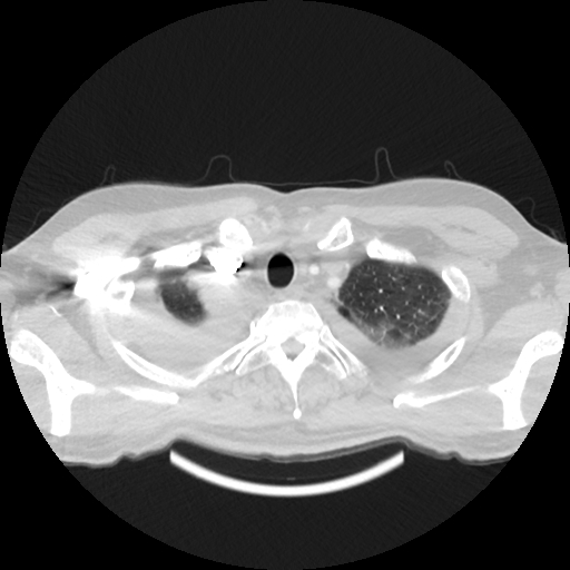 Cardiac tamponade (Radiopaedia 78607-91368 Axial lung window 4).jpg
