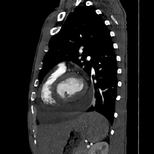 File:Cardiac tumor - undifferentiated pleomorphic sarcoma (Radiopaedia 45844-50134 B 23).png
