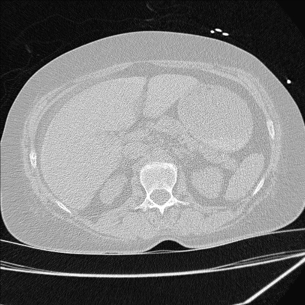 Cardiogenic pulmonary edema (Radiopaedia 29213-29609 Axial lung window 116).jpg