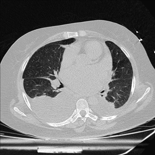 Cardiogenic pulmonary edema (Radiopaedia 29213-29609 Axial lung window 51).jpg