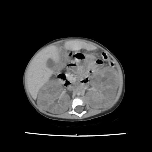 Caroli disease with autosomal recessive polycystic kidney disease (ARPKD) (Radiopaedia 89651-106703 B 109).jpg