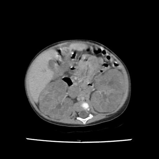 File:Caroli disease with autosomal recessive polycystic kidney disease (ARPKD) (Radiopaedia 89651-106703 B 114).jpg