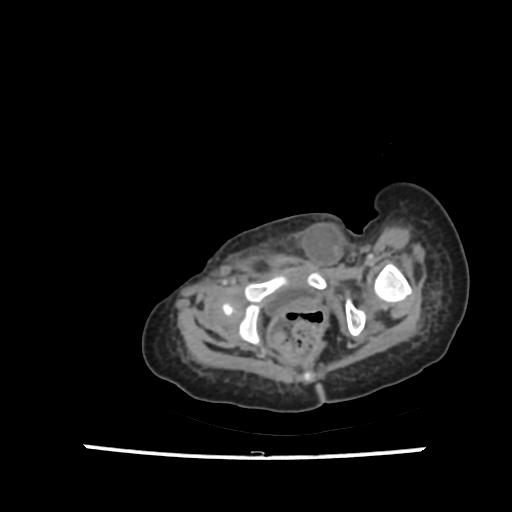 Caroli disease with autosomal recessive polycystic kidney disease (ARPKD) (Radiopaedia 89651-106703 B 223).jpg