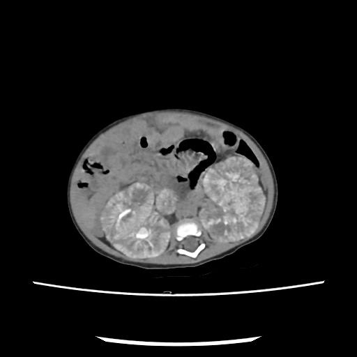 Caroli disease with autosomal recessive polycystic kidney disease (ARPKD) (Radiopaedia 89651-106703 E 117).jpg