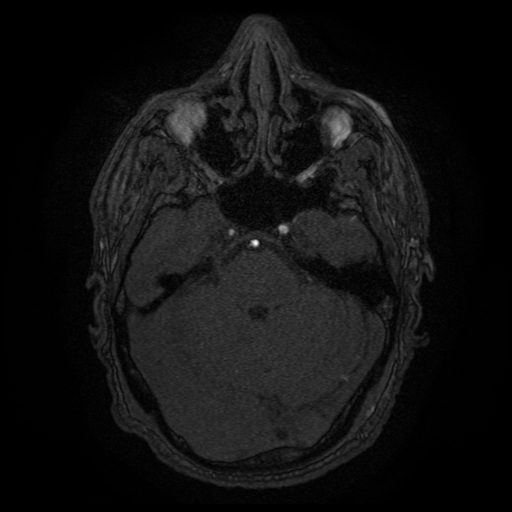 Carotid arterial dissection with acute cerebral infarction (Radiopaedia 26636-26784 MRA 123).jpg