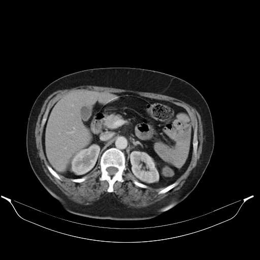 File:Carotid body tumor (Radiopaedia 21021-20948 A 59).jpg