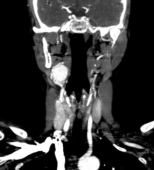File:Carotid body tumor (Radiopaedia 39845-42300 C 18).jpg