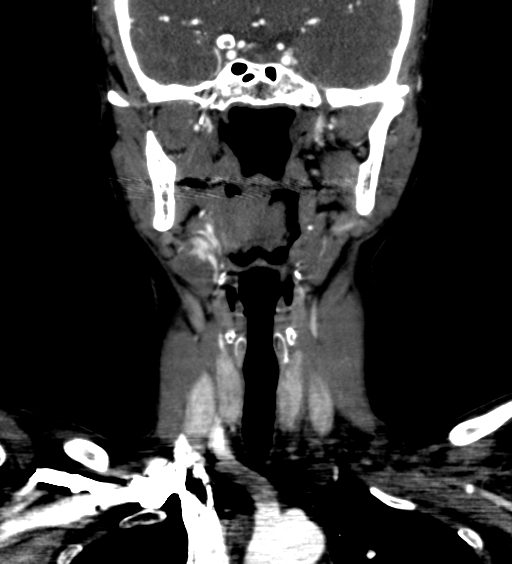 File:Carotid body tumor (Radiopaedia 39845-42300 C 4).jpg