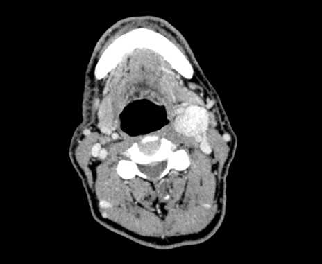 Carotid body tumor (Radiopaedia 61750-69757 Axial Post contrast 47).jpg
