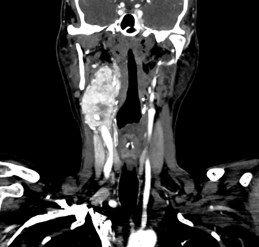 File:Carotid body tumor (Radiopaedia 83615-98727 B 62).jpg