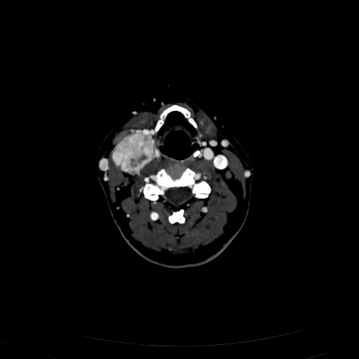 Carotid body tumor (Radiopaedia 83615-98727 D 64).jpg