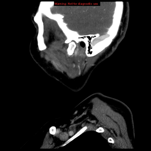 File:Carotid body tumor with lung metastases (Radiopaedia 9301-9986 Sagittal C+ delayed 5).jpg