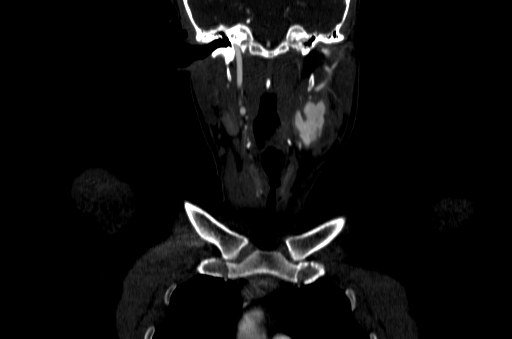 File:Carotid bulb pseudoaneurysm (Radiopaedia 57670-64616 D 11).jpg